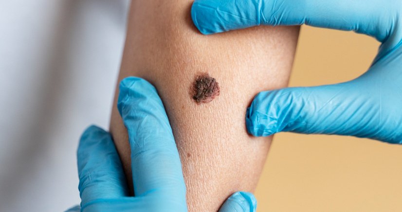 mole removal in banashankari, bangalore​